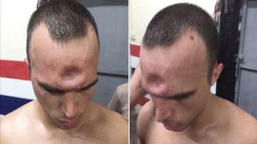 Jonny Betts : sa terrible blessure au crâne en Muay-thaï ! (Vidéo)