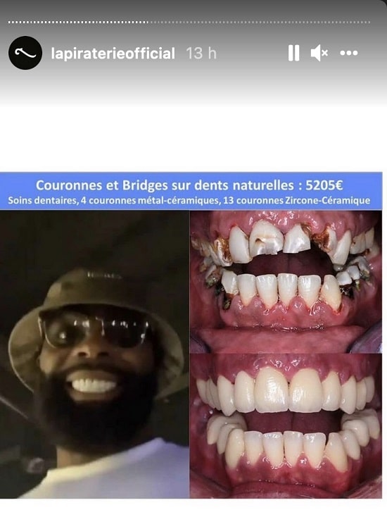 Booba ridiculise la nouvelle dentition de Kaaris 4