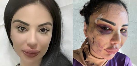 Une influenceuse paye 600 000 € pour ressembler à Kim Kardashian puis 120 000 € pour tout inverser
